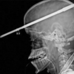 10 Spine-Chilling Medical X-Rays
